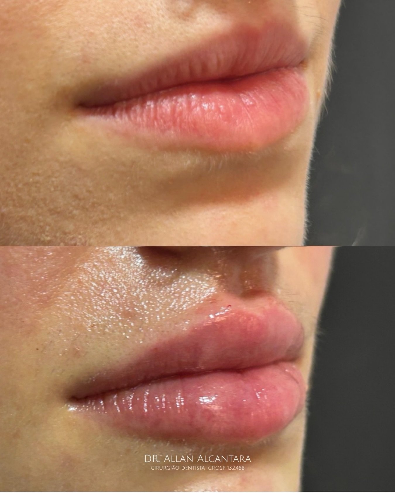 Harmonização facial antes e depois