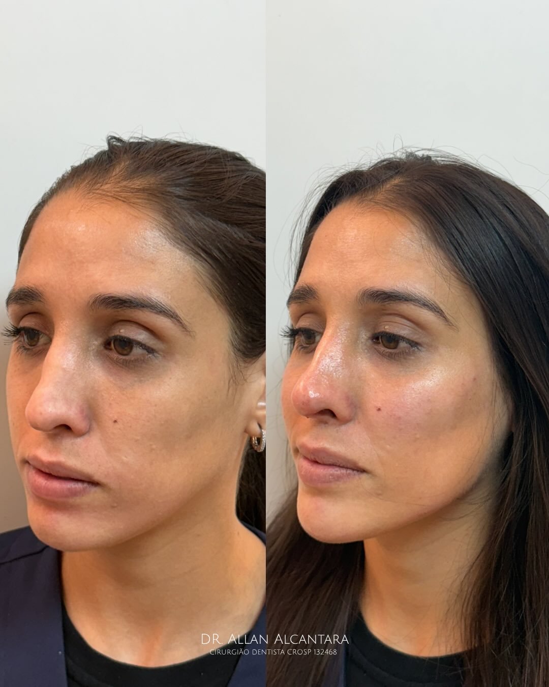 Harmonização facial resultado natural